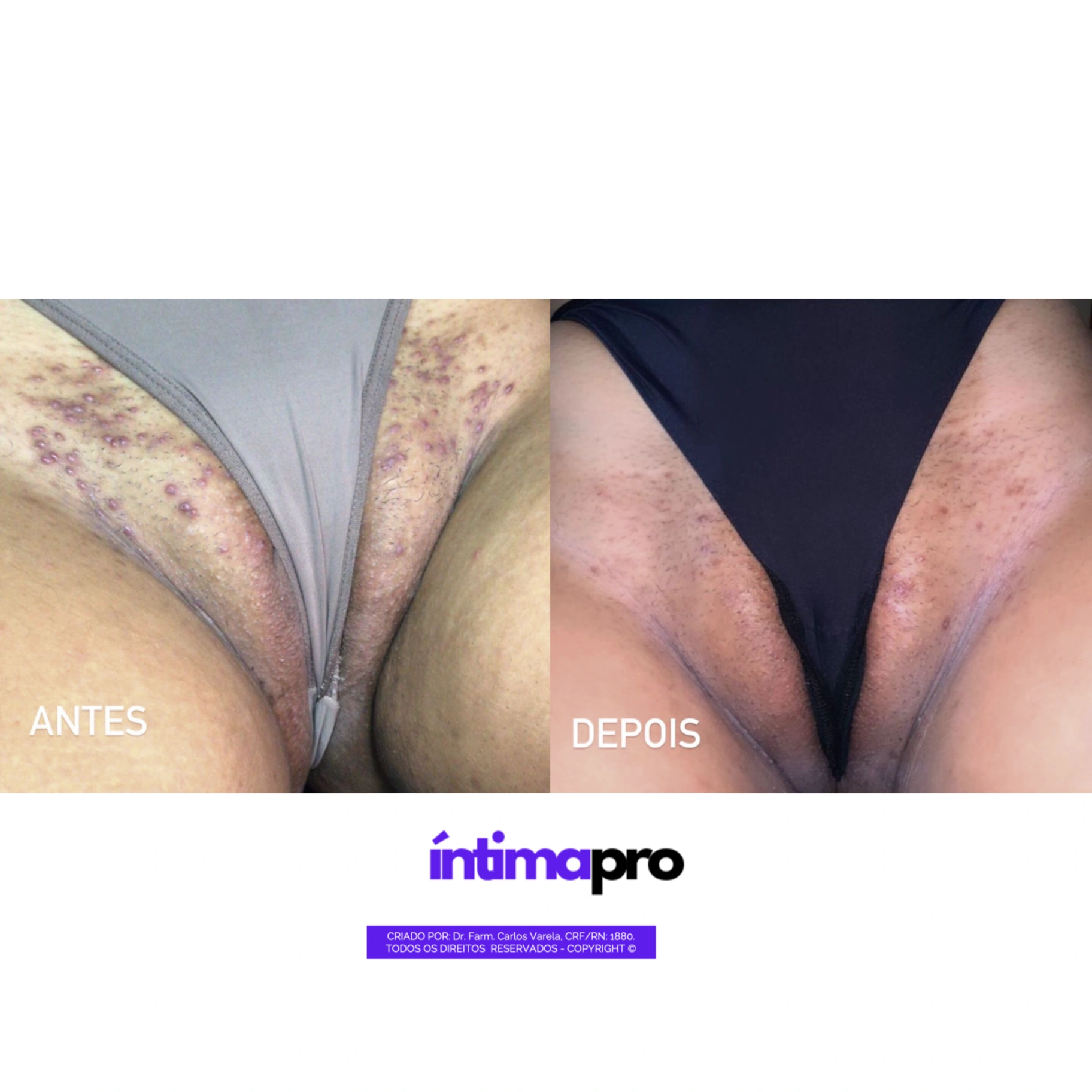 Caso real — Foliculitis y textura